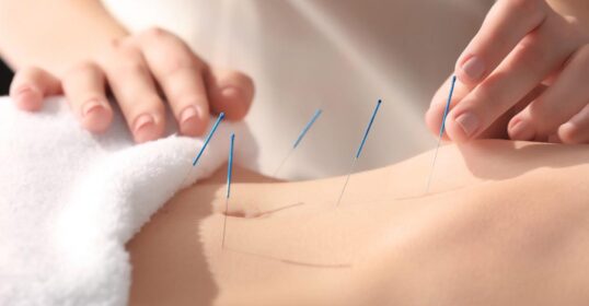 Billeder viser kvinde der modtager barnløshedsbehandling med akupunktur