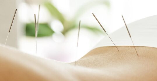 Billede af kvinde som modtager lændesmerter behandling med akupunktur
